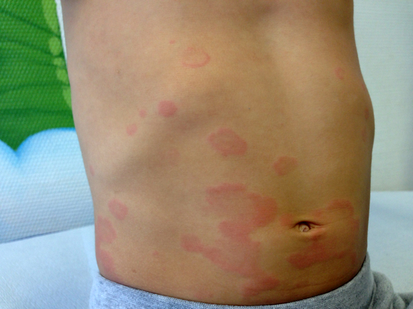 Alergia na pele o que causa tipos de alergia e como tratar Médico Responde
